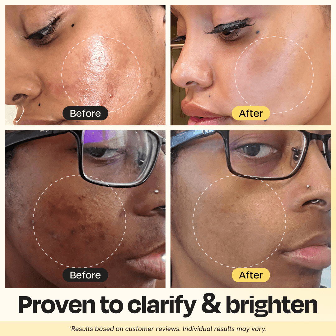 Vitamin C Clay Mask – Fè Po Ou Klere Natirèlman

✨ Ou bouke ak bouton, tach nwa, ak po ki pa klere?
Mask sa a se solisyon ou!

Vitamin C Clay Mask la se yon tretman 3-an-1 ki ede netwaye po ou an pwofondè, retire enpurte, epi bay ou yon figi ki klere epi lis nan sèlman 10 minit.
